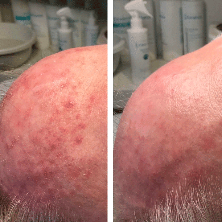 Behandling af hudsygdom og hudproblemer -Rosacea - Hos klinik Marianne Bisgaard i Vejle