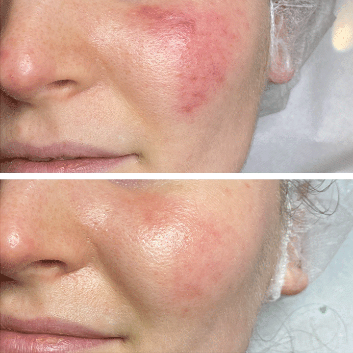 Behandling af hudsygdom og hudproblemer -Rosacea - Hos klinik Marianne Bisgaard i Vejle