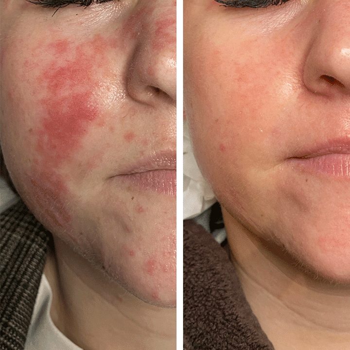 Behandling af hudsygdom og hudproblemer -Rosacea - Hos klinik Marianne Bisgaard i Vejle