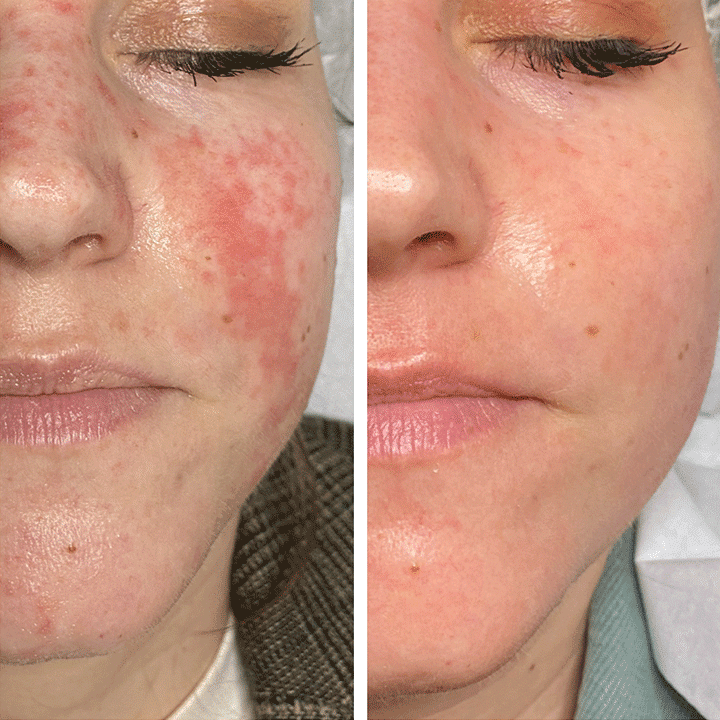 Behandling af hudsygdom og hudproblemer -Rosacea - Hos klinik Marianne Bisgaard i Vejle