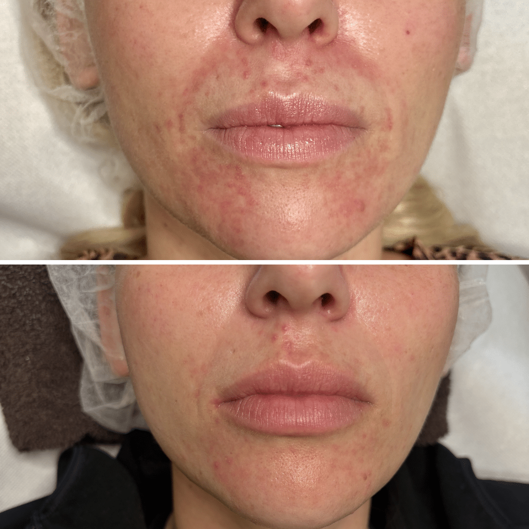 Perioral dermatitis - Før og efter behandling - Hos Klinik Marianne Bisgaard