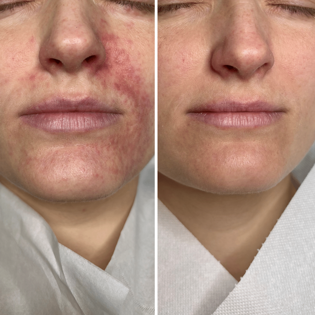Perioral dermatitis - Før og efter behandling - Hos Klinik Marianne Bisgaard