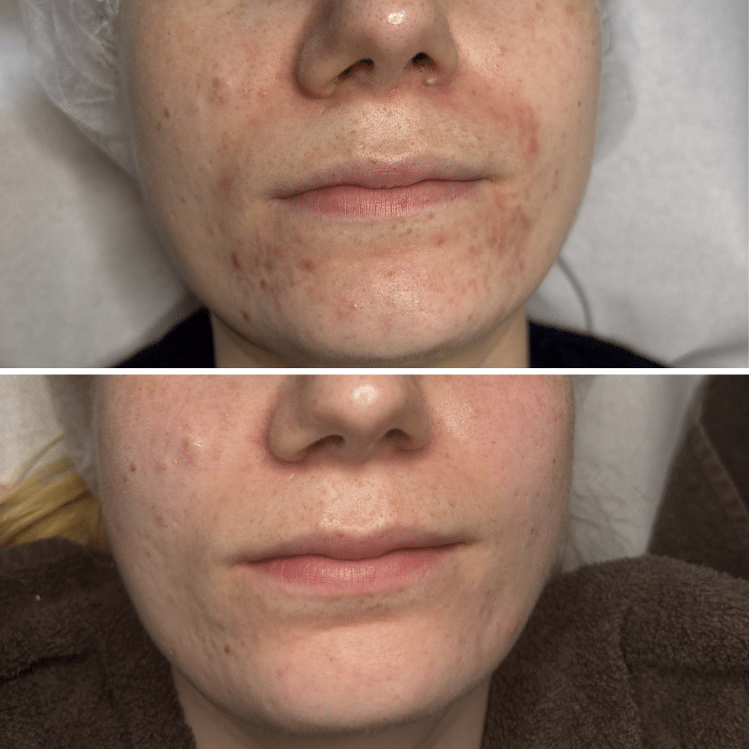 Perioral dermatitis - Før og efter behandling - Hos Klinik Marianne Bisgaard
