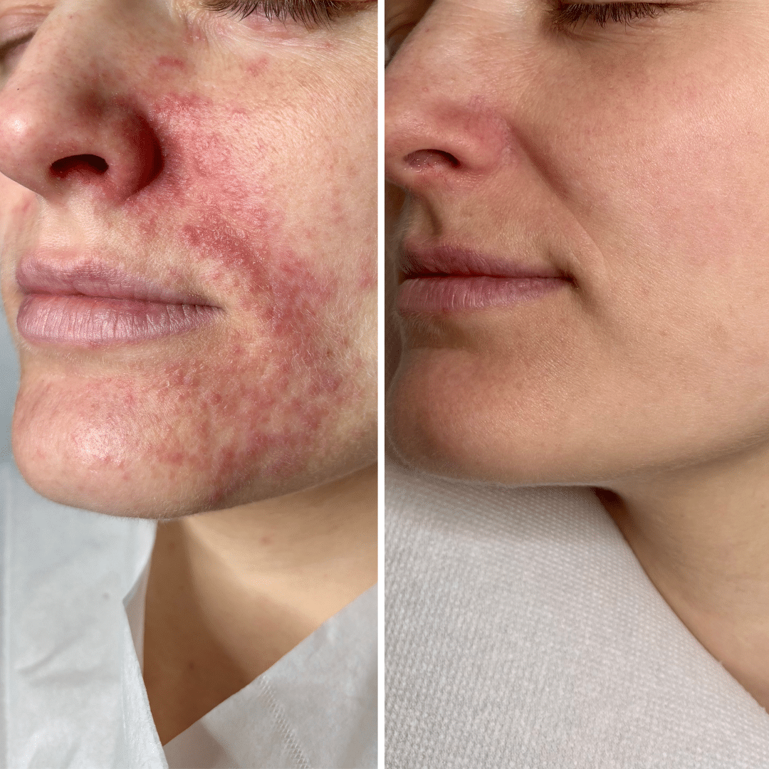 Perioral dermatitis - Før og efter behandling - Hos Klinik Marianne Bisgaard