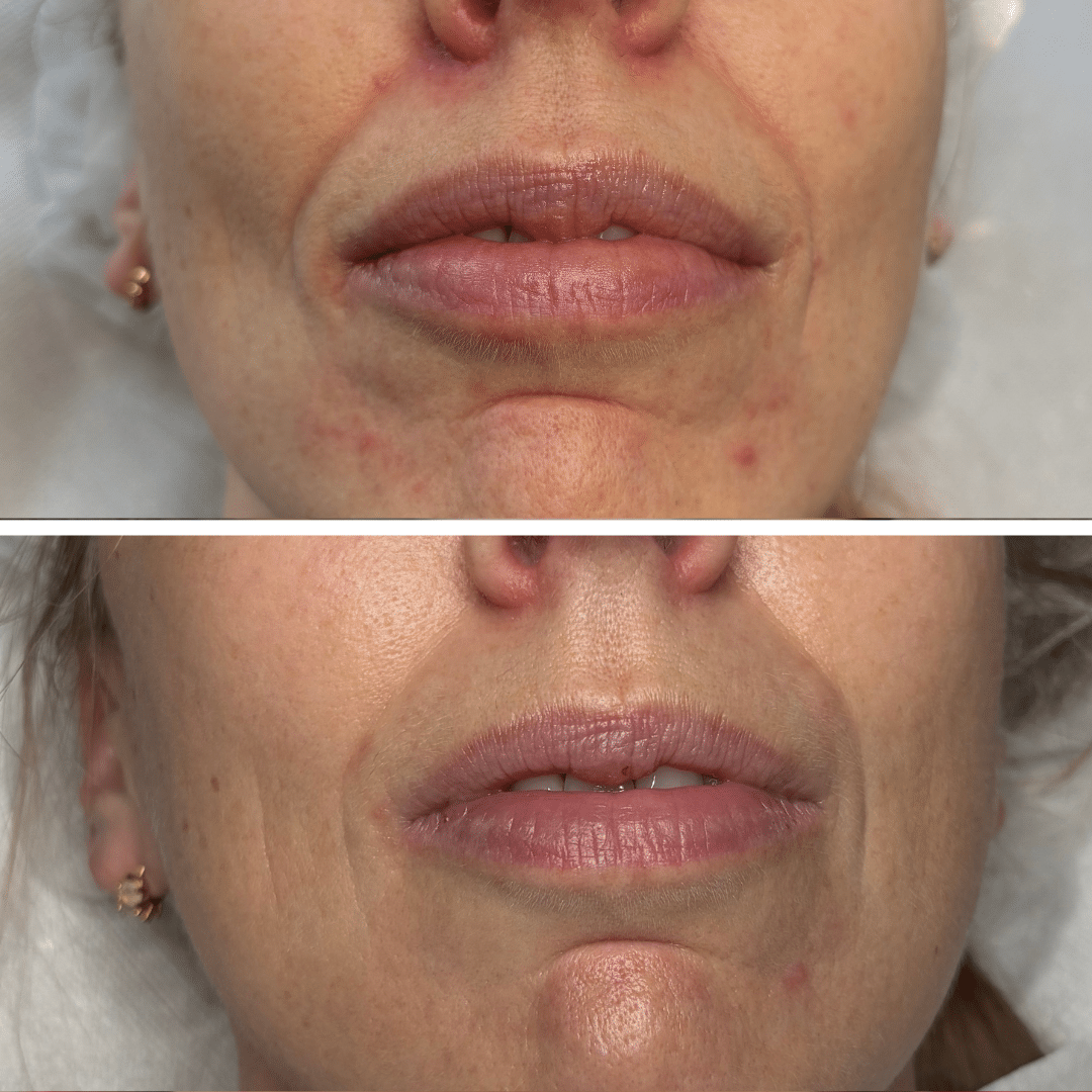 Perioral dermatitis - Behandling hos Klinik Marianne Bisgaard i Vejle