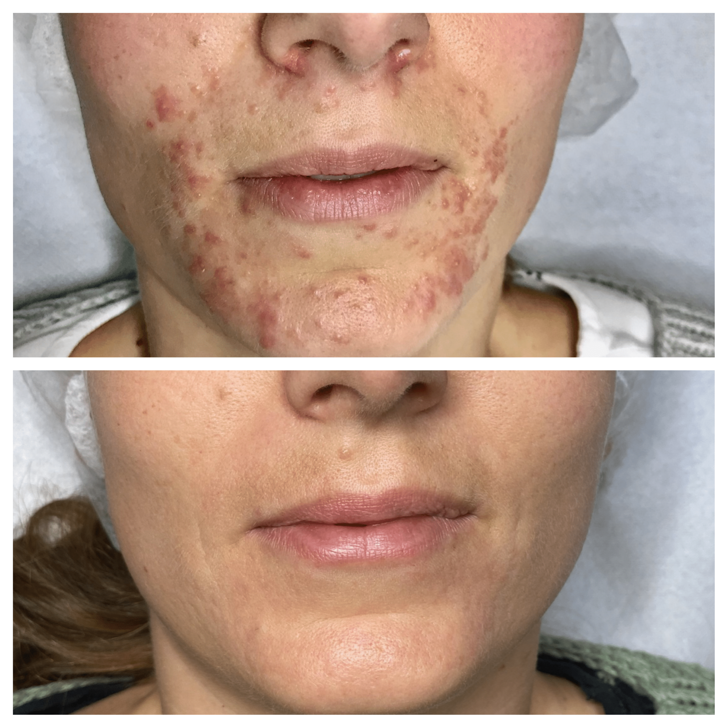Perioral dermatitis - Behandling hos Klinik Marianne Bisgaard i Vejle