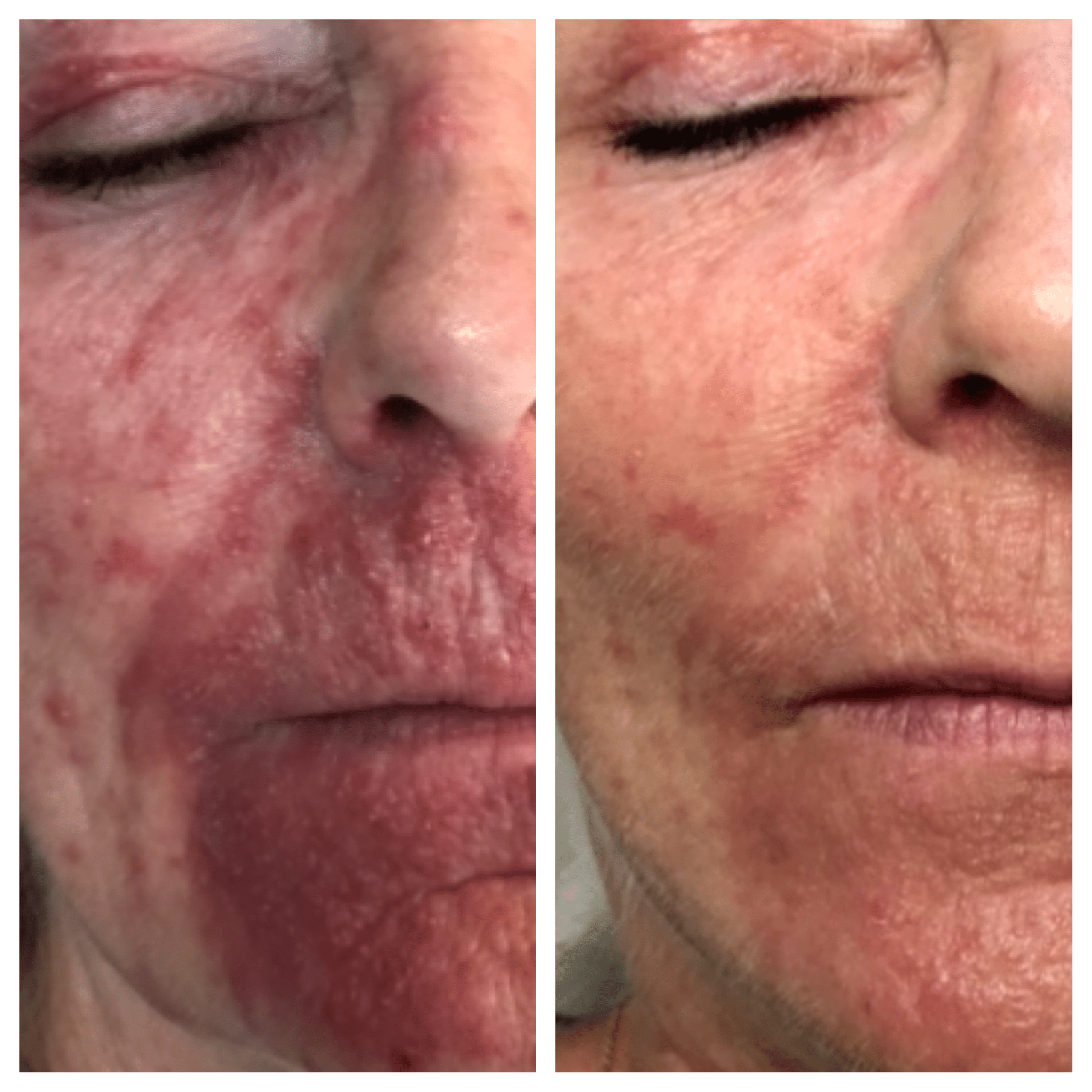 Perioral dermatitis - Behandling hos Klinik Marianne Bisgaard i Vejle