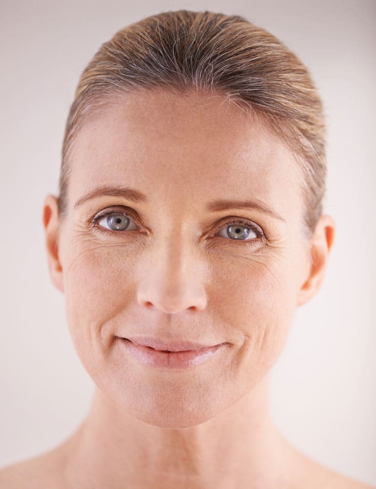 Meso Cheek lift