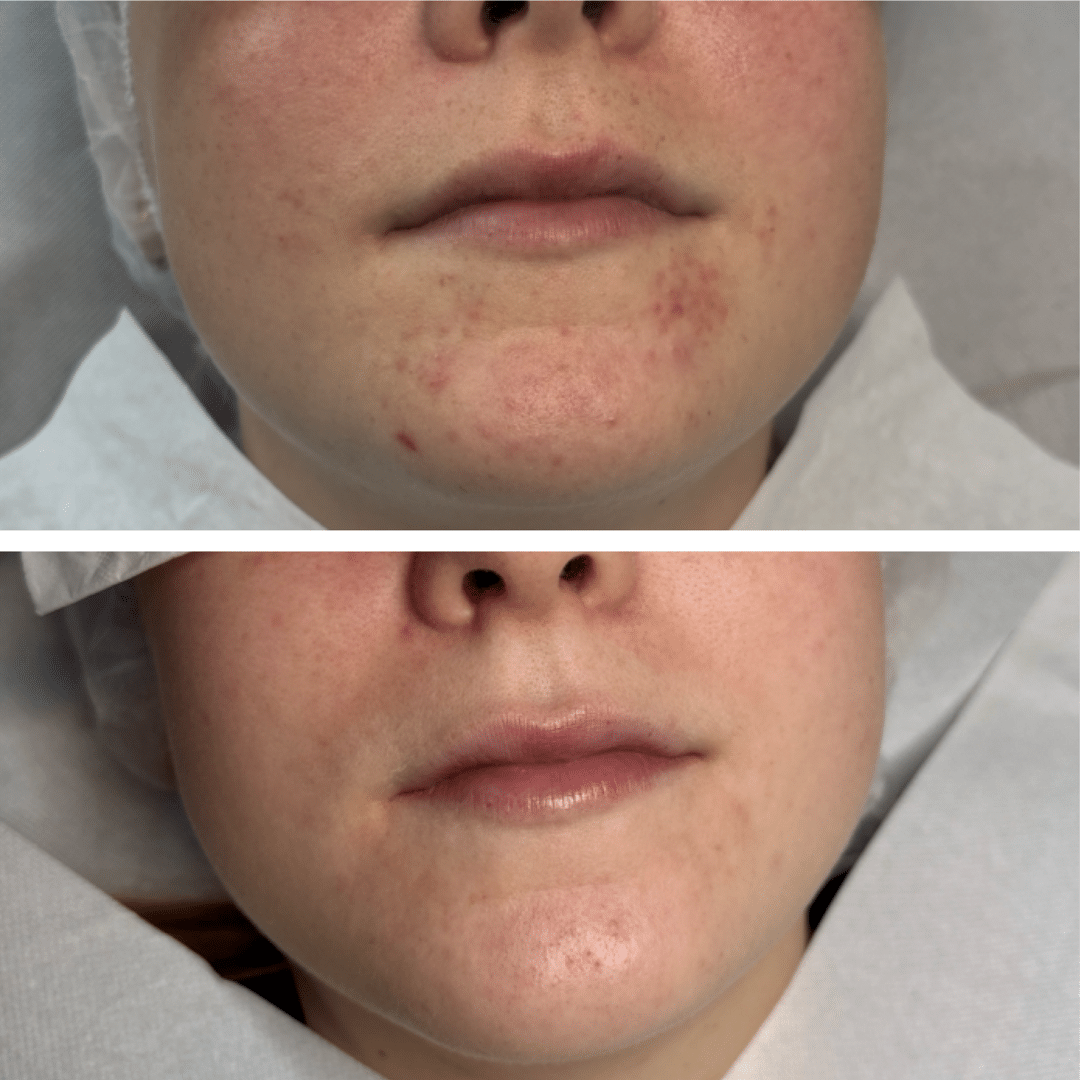 Behandling af Perioral dermatitis - Hos Klinik Marianne Bisgaard i Vejle