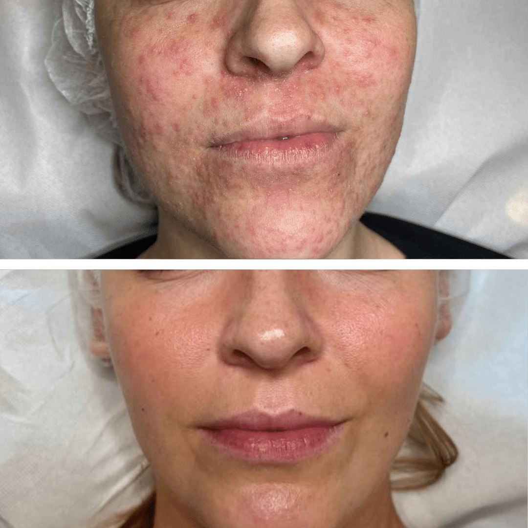 Behandling af hudproblemer og Perioral dermatitis - Hos Klinik Marianne Bisgaard i Vejle