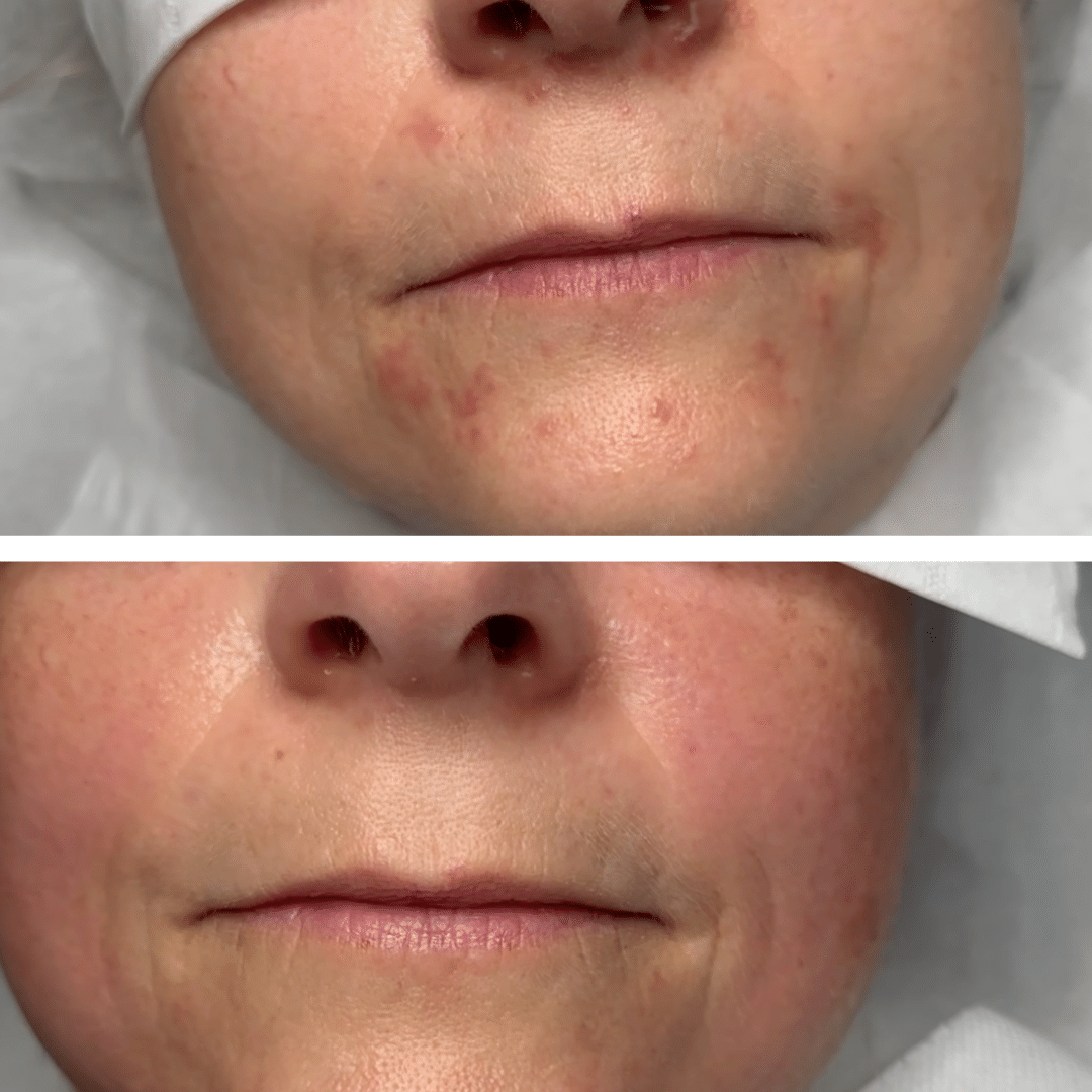 Før og efter behandlingsforløb mod perioral dermatitis med tydelig forbedring af rødme og hudstruktur omkring munden.