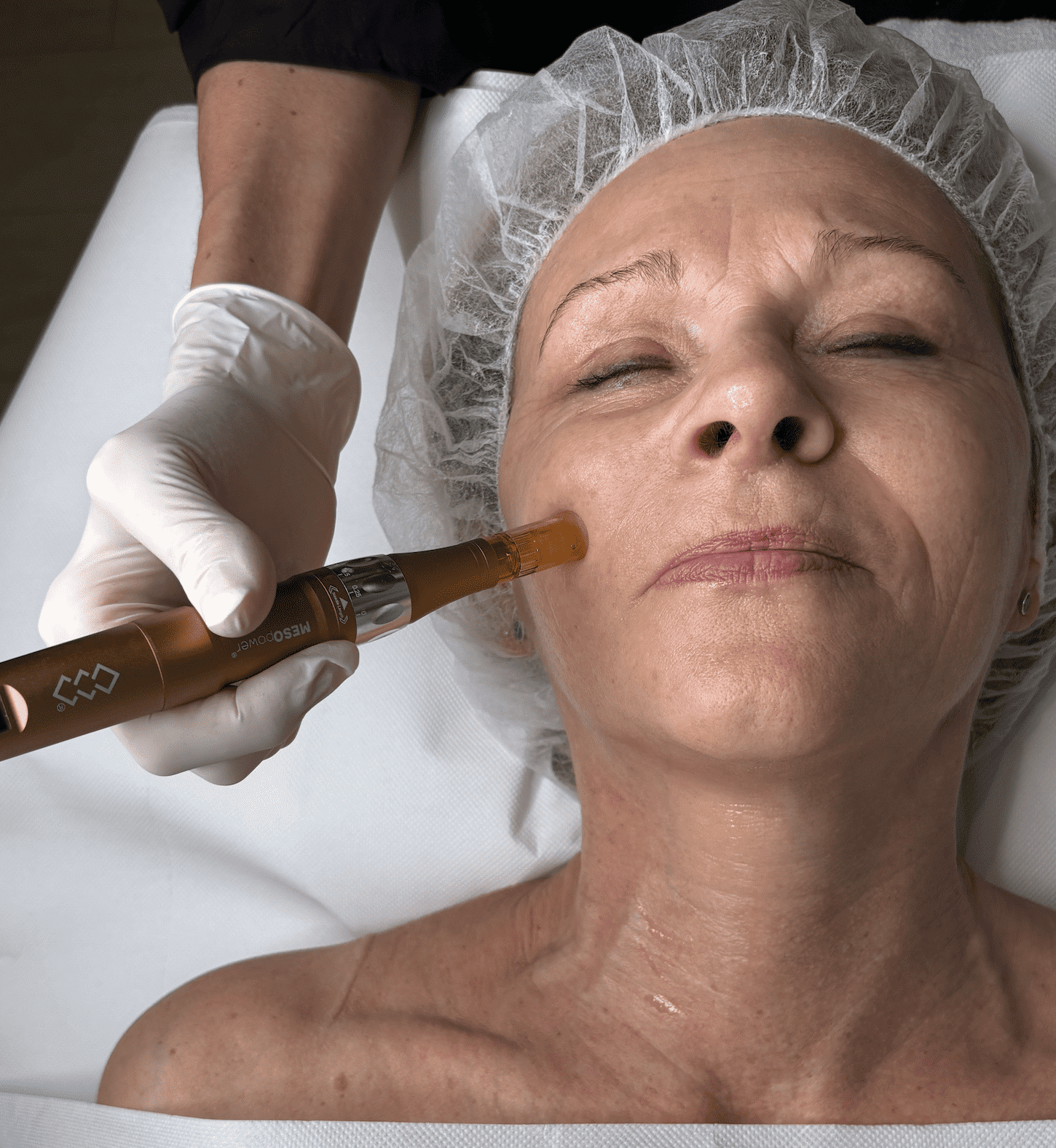 Mesoterapi I Vejle -Effektiv anti-age og alternativ til botox